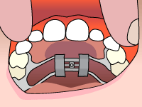 palatal-expander-step1